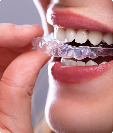 Invisalign - Teeth Straightening Doral, FL - Dr. Del Puerto - Smiles at Doral - Teeth Straightening near me